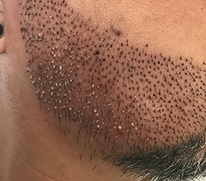 PRP (Platelet-Rich Plasma)