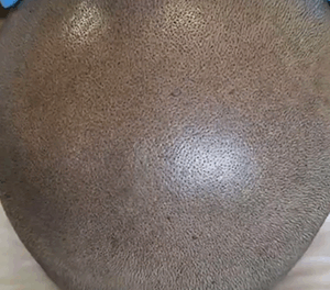 SMP (Medical Scalp Micro-Pigmentation)